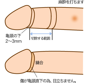 亀頭直下埋没法の解説