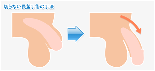 切らない長茎手術の手法