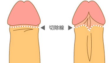 切除線